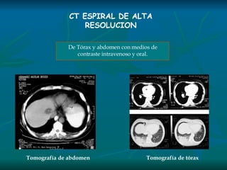 CT ESPIRAL DE ALTA RESOLUCION De Tórax y abdomen con medios de contraste intravenoso y oral. Tomografía de tórax Tomografía de abdomen 
