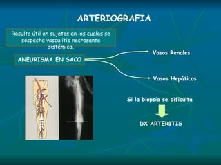 ARTERIOGRAFIA Resulta útil en sujetos en los cuales se sospecha vasculitis necrosante sistémica. Vasos Renales Vasos Hepáticos ANEURISMA EN SACO Si la biopsia se dificulta  DX ARTERITIS 