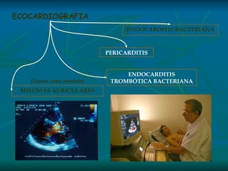 ECOCARDIOGRAFIA ENDOCARDITIS BACTERIANA PERICARDITIS ENDOCARDITIS TROMBÓTICA BACTERIANA MIXOMAS AURICULARES (Tumor como péndulo) 