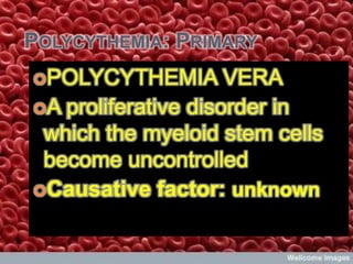 POLYCYTHEMIA: PRIMARY
POLYCYTHEMIA        VERA




                                Colleen C. Flores, RN
A proliferative disorder in
 which the myeloid stem cells
 become uncontrolled
Causative factor: unknown
 