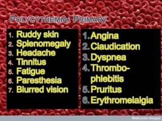 POLYCYTHEMIA: PRIMARY
1.   Ruddy skin       1. Angina
2.   Splenomegaly     2. Claudication
3.   Headache
                      3. Dyspnea
4.   Tinnitus
5.   Fatigue          4. Thrombo-
6.   Paresthesia         phlebitis
7.   Blurred vision   5. Pruritus
                      6. Erythromelalgia
 