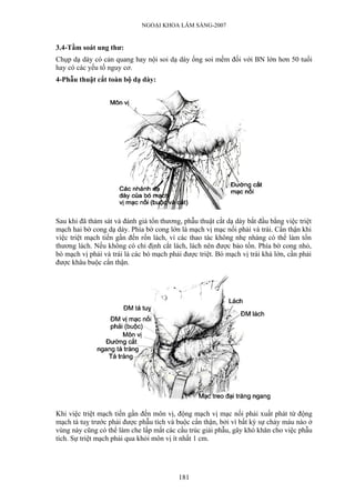 NGOẠI KHOA LÂM SÀNG-2007


3.4-Tầm soát ung thư:
Chụp dạ dày có cản quang hay nội soi dạ dày ống soi mềm đối với BN lớn hơn 50 tuổi
hay có các yếu tố nguy cơ.
4-Phẫu thuật cắt toàn bộ dạ dày:




Sau khi đã thám sát và đánh giá tổn thương, phẫu thuật cắt dạ dày bắt đầu bằng việc triệt
mạch hai bờ cong dạ dày. Phía bờ cong lớn là mạch vị mạc nối phải và trái. Cẩn thận khi
việc triệt mạch tiến gần đến rốn lách, vì các thao tác không nhẹ nhàng có thể làm tổn
thương lách. Nếu không có chỉ định cắt lách, lách nên được bảo tồn. Phía bờ cong nhỏ,
bó mạch vị phải và trái là các bó mạch phải được triệt. Bó mạch vị trái khá lớn, cần phải
được khâu buộc cẩn thận.




Khi việc triệt mạch tiến gần đến môn vị, động mạch vị mạc nối phải xuất phát từ động
mạch tá tuỵ trước phải được phẫu tích và buộc cẩn thận, bởi vì bất kỳ sự chảy máu nào ở
vùng này cũng có thể làm che lấp mất các cấu trúc giải phẫu, gây khó khăn cho việc phẫu
tích. Sự triệt mạch phải qua khỏi môn vị ít nhất 1 cm.




                                          181
 
