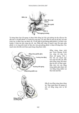 NGOẠI KHOA LÂM SÀNG-2007




Tá tràng được kẹp cắt ngang và được khâu đóng lại.Việc giải phóng dạ dày tiếp tục lên
đến tâm vị từ phía phình vị và phía bờ cong nhỏ. Các dây dính từ mặt sau dạ dày vào mặt
trước tuỵ và phúc mạc sau được cắt. Tế nhị nhất là giải phóng phần phình vị ra khỏi vòm
hoành, vì thao tác trên vùng này rất sâu. Phẫu tích vùng vô mạch ở góc His (góc giữa
phình vị và vùng nối) trước sẽ làm cho việc giải phóng phình vị được dễ dàng hơn. Các
mạch máu nhỏ đến nuôi thực quản bụng cũng được triệt).

                                                             Hỗng tràng, đoạn cách
                                                             góc Treitz khoảng 30-40
                                                             cm, cùng với mạc treo
                                                             được cắt ngang. Chú ý
                                                             bảo tồn các mạch mạc
                                                             treo nuôi hai đầu cắt. Đầu
                                                             dưới hỗng tràng (B) được
                                                             đưa lên nối với thực quản.
                                                             Đầu trên (A) của hỗng
                                                             tràng (phần gần) được nối
                                                             vào hỗng tràng (phần xa)
                                                             theo kiểu tận-bên.




                                                      Đầu B của hỗng tràng được đóng
                                                      lại. Thực quản được cắt ngang và
                                                      nối với hỗng tràng như sơ đồ
                                                      trên.




                                         182
 