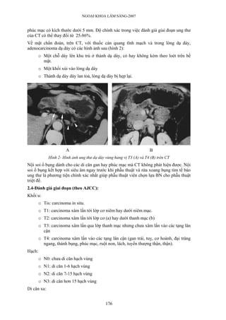NGOẠI KHOA LÂM SÀNG-2007


phúc mạc có kích thước dưới 5 mm. Độ chính xác trong việc đánh giá giai đoạn ung thư
của CT có thể thay đổi từ 25-86%.
Về mặt chẩn đoán, trên CT, với thuốc cản quang tĩnh mạch và trong lòng dạ dày,
adenocarcinoma dạ dày có các hình ảnh sau (hình 2):
        o Một chỗ dày lên khu trú ở thành dạ dày, có hay không kèm theo loét trên bề
          mặt.
        o Một khối xùi vào lòng dạ dày
        o Thành dạ dày dày lan toả, lòng dạ dày bị hẹp lại.




                      A                                               B
             Hình 2- Hình ảnh ung thư dạ dày vùng hang vị T3 (A) và T4 (B) trên CT
Nội soi ổ bụng dành cho các di căn gan hay phúc mạc mà CT không phát hiện được. Nội
soi ổ bụng kết hợp với siêu âm ngay trước khi phẫu thuật và rửa xoang bụng tìm tế bào
ung thư là phương tiện chính xác nhất giúp phẫu thuật viên chọn lựa BN cho phẫu thuật
triệt để.
2.4-Đánh giá giai đoạn (theo AJCC):
Khối u:
        o Tis: carcinoma in situ.
        o T1: carcinoma xâm lấn tới lớp cơ niêm hay dưới niêm mạc.
        o T2: carcinoma xâm lấn tới lớp cơ (a) hay dưới thanh mạc (b)
        o T3: carcinoma xâm lấn qua lớp thanh mạc nhưng chưa xâm lấn vào các tạng lân
          cận
        o T4: carcinoma xâm lấn vào các tạng lân cận (gan trái, tuỵ, cơ hoành, đại tràng
          ngang, thành bụng, phúc mạc, ruột non, lách, tuyến thượng thận, thận).
Hạch:
        o N0: chưa di căn hạch vùng
        o N1: di căn 1-6 hạch vùng
        o N2: di căn 7-15 hạch vùng
        o N3: di căn hơn 15 hạch vùng
Di căn xa:


                                             176
 