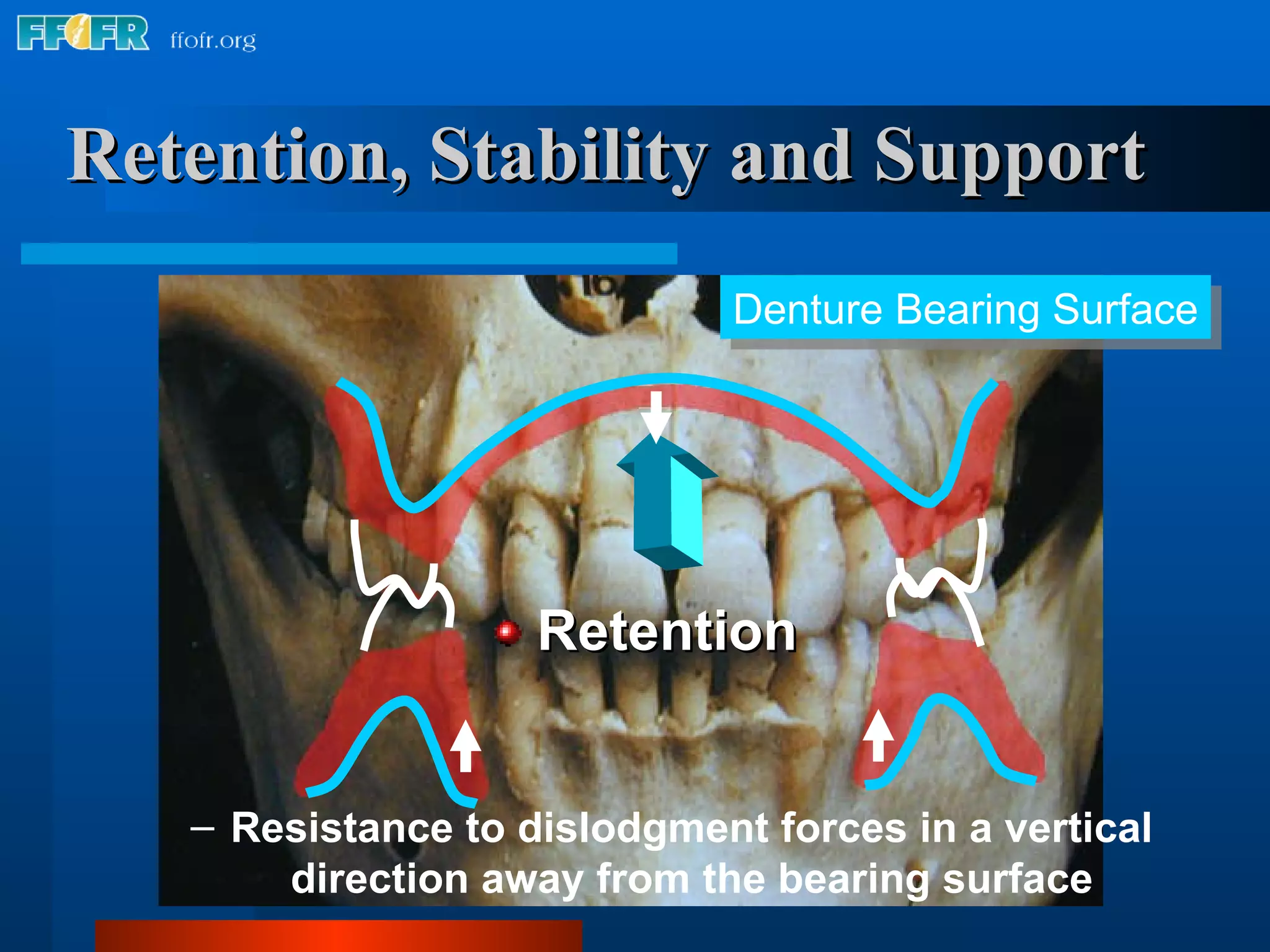 Retention, Stability and Support Retention Denture Bearing Surface Resistance to dislodgment forces in a vertical direction away from the bearing surface 