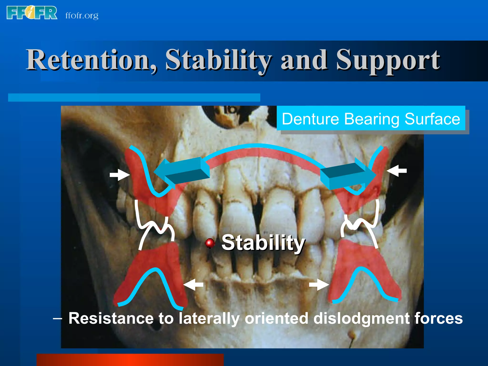 Retention, Stability and Support Stability Denture Bearing Surface Resistance to laterally oriented dislodgment forces 