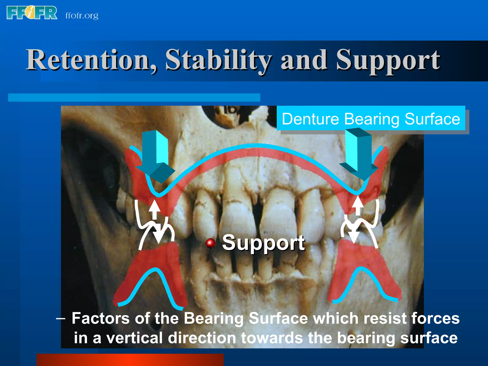 Retention, Stability and Support Support Denture Bearing Surface Factors of the Bearing Surface which resist forces in a vertical direction towards the bearing surface 