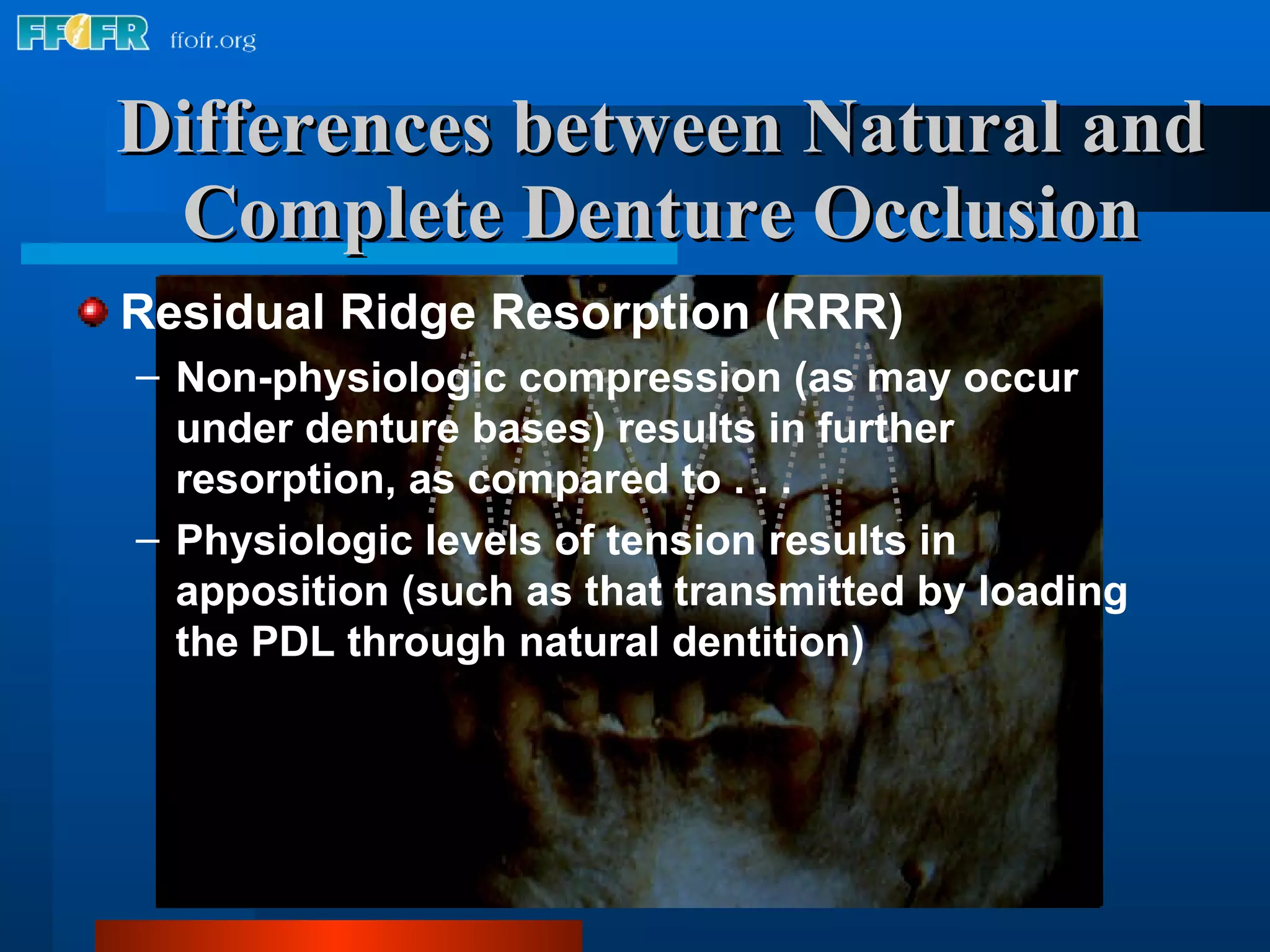 Differences between Natural and Complete Denture Occlusion Residual Ridge Resorption (RRR) Non-physiologic compression (as may occur under denture bases) results in further resorption, as compared to . . . Physiologic levels of tension results in apposition (such as that transmitted by loading the PDL through natural dentition) 