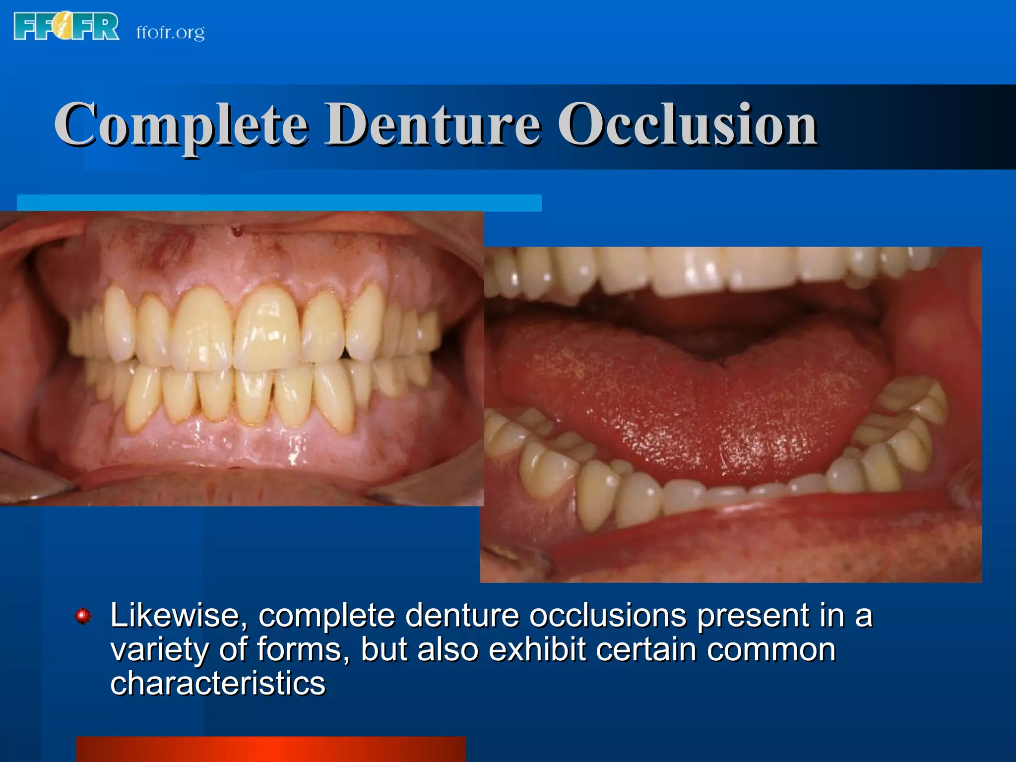 Complete Denture Occlusion Likewise, complete denture occlusions present in a variety of forms, but also exhibit certain common characteristics 