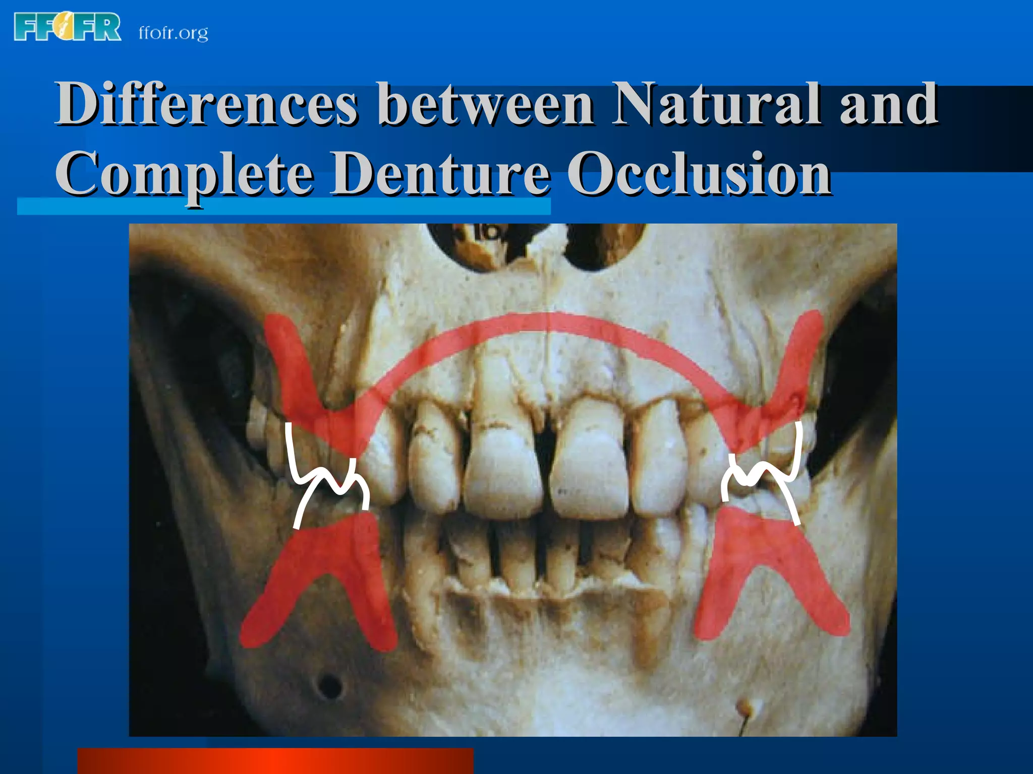 Differences between Natural and Complete Denture Occlusion 