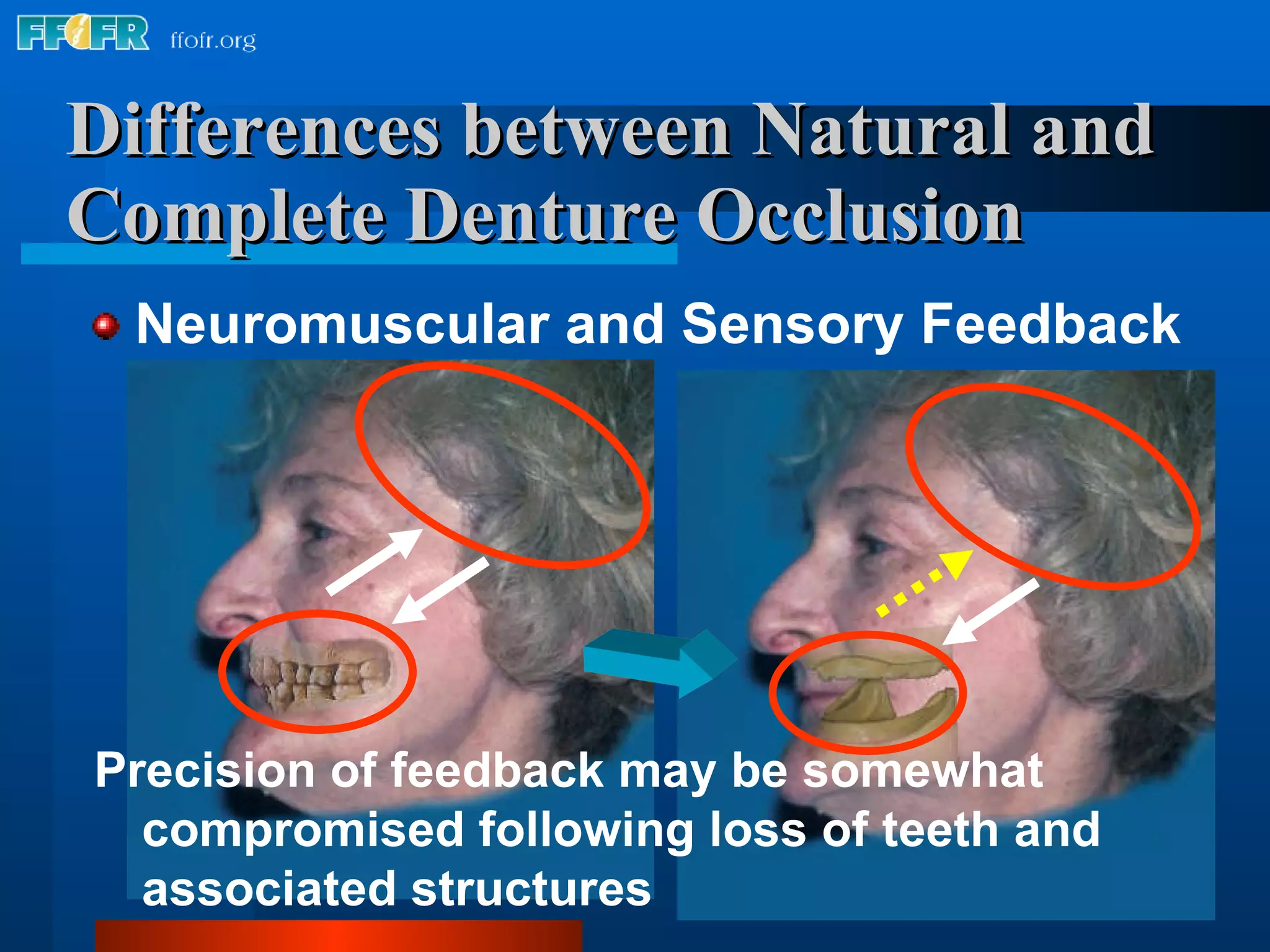 Differences between Natural and Complete Denture Occlusion Neuromuscular and Sensory Feedback Precision of feedback may be somewhat compromised following loss of teeth and associated structures 