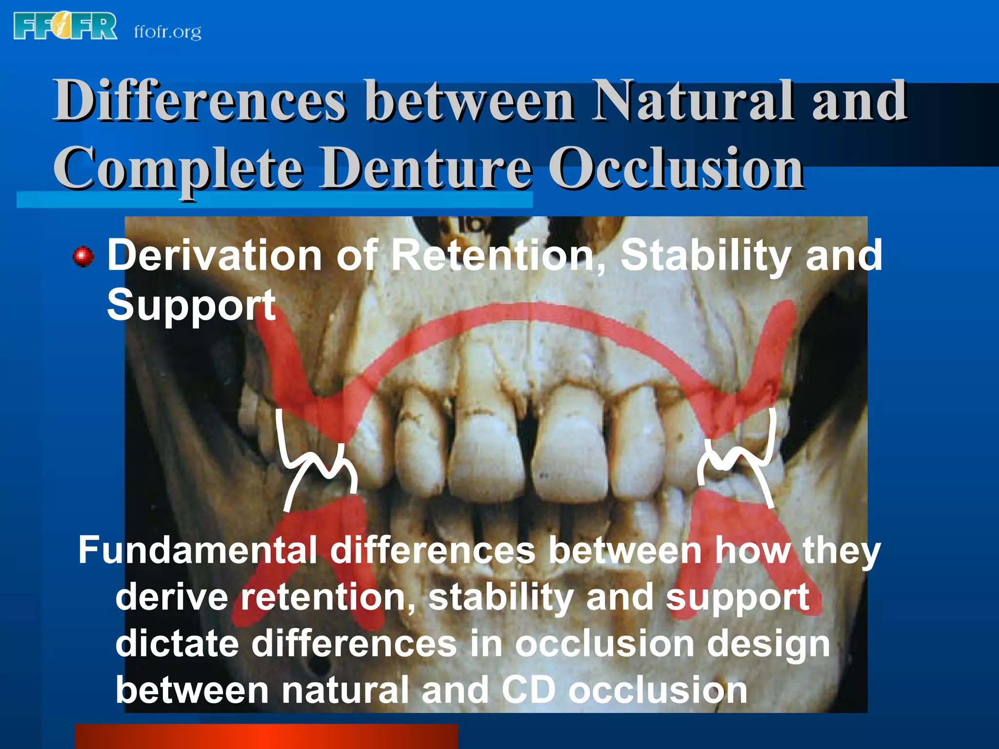 Differences between Natural and Complete Denture Occlusion Derivation of Retention, Stability and Support Fundamental differences between how they derive retention, stability and support dictate differences in occlusion design between natural and CD occlusion 