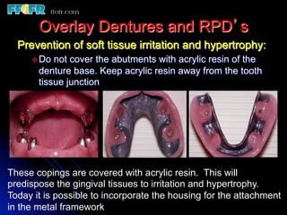 Overlay Metal Rpd 13.overlay rpd’s | PDF