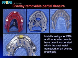 Overlay Metal Rpd 13.overlay rpd’s | PDF