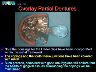 Overlay Metal Rpd 13.overlay rpd’s | PDF