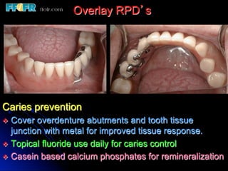Overlay Metal Rpd 13.overlay rpd’s | PDF