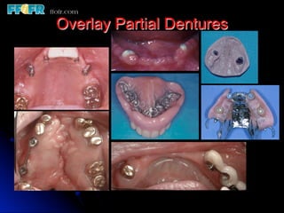 Overlay Metal Rpd 13.overlay rpd’s | PDF