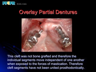 Overlay Metal Rpd 13.overlay rpd’s | PDF