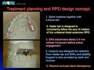 Overlay Metal Rpd 13.overlay rpd’s | PDF