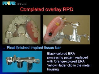Overlay Metal Rpd 13.overlay rpd’s | PDF