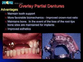 Overlay Metal Rpd 13.overlay rpd’s | PDF