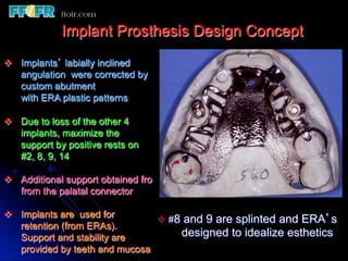 Overlay Metal Rpd 13.overlay rpd’s | PDF