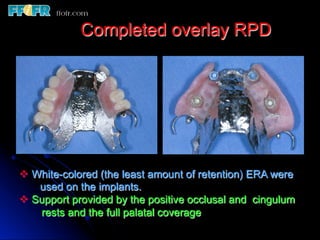 13.overlay rpd’s | PDF