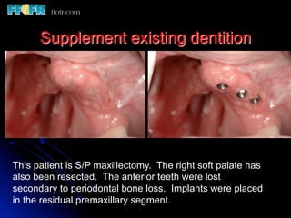 Overlay Metal Rpd 13.overlay rpd’s | PDF