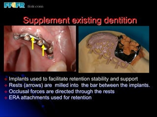Overlay Metal Rpd 13.overlay rpd’s | PDF