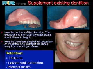 Overlay Metal Rpd 13.overlay rpd’s | PDF