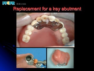Overlay Metal Rpd 13.overlay rpd’s | PDF