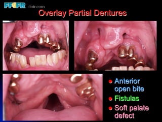 Overlay Metal Rpd 13.overlay rpd’s | PDF