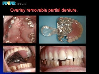 Overlay Metal Rpd 13.overlay rpd’s | PDF