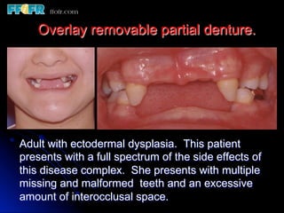 Overlay Metal Rpd 13.overlay rpd’s | PDF