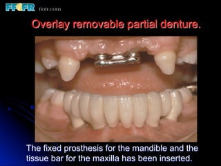 Overlay Metal Rpd 13.overlay rpd’s | PDF