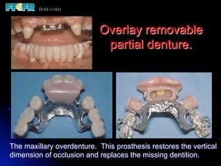 Overlay Metal Rpd 13.overlay rpd’s | PDF