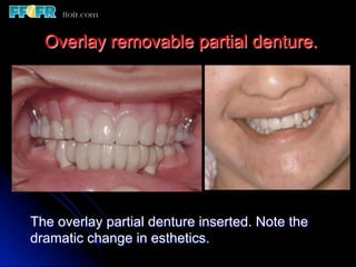 Overlay Metal Rpd 13.overlay rpd’s | PDF