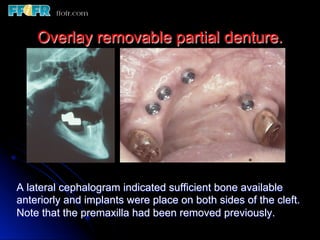 Overlay Metal Rpd 13.overlay rpd’s | PDF