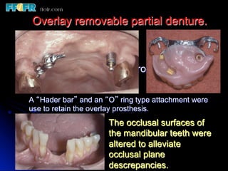 Overlay Metal Rpd 13.overlay rpd’s | PDF