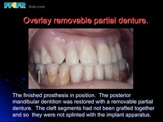 Overlay Metal Rpd 13.overlay rpd’s | PDF