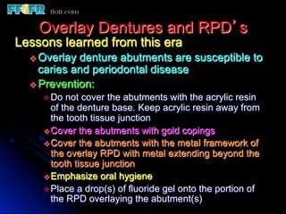 Overlay Metal Rpd 13.overlay rpd’s | PDF