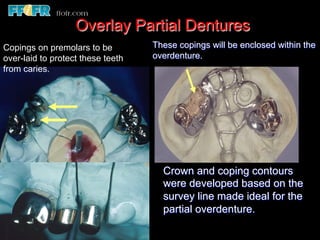 Overlay Metal Rpd 13.overlay rpd’s | PDF