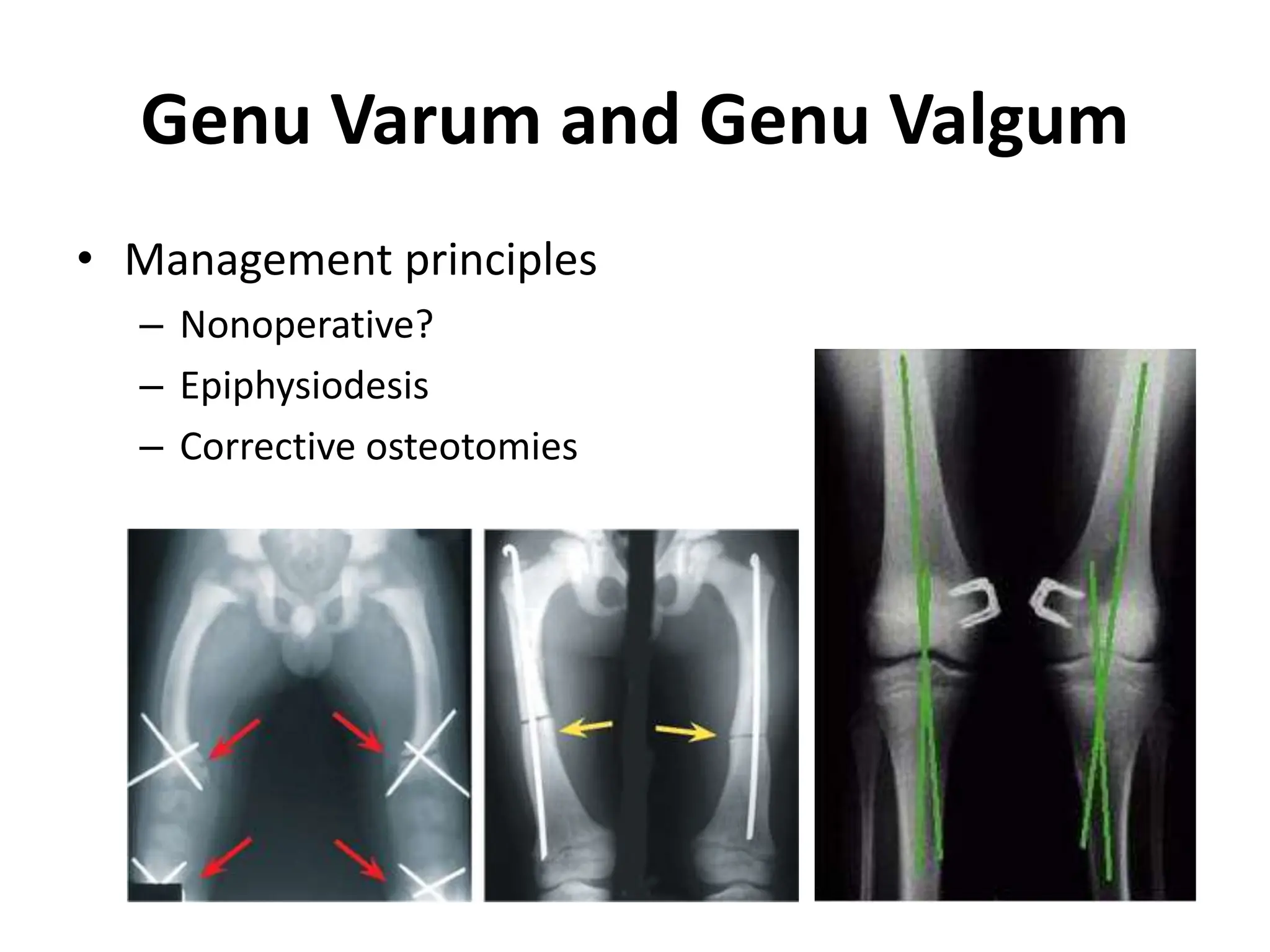 13-pediatric common lower limb disorders.ppt