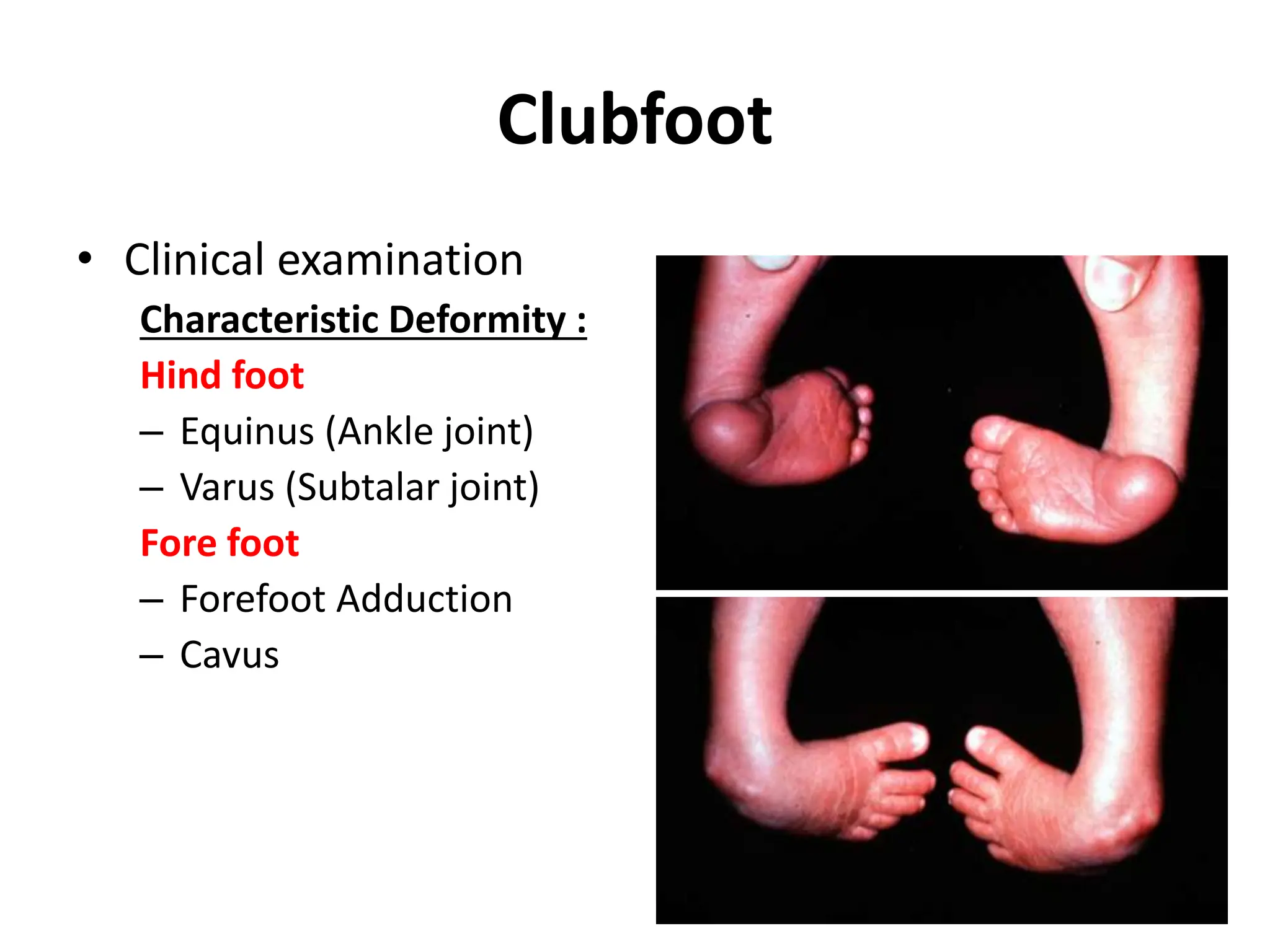 13-pediatric common lower limb disorders.ppt