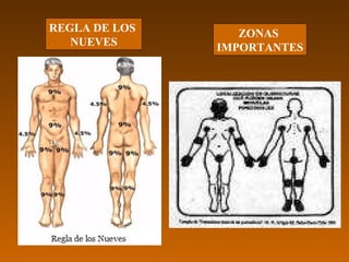 ZONAS  IMPORTANTES REGLA DE LOS  NUEVES 