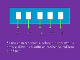 5’  4’  3’  2’  1’ Se não aparecer eritema, coloca o dispositivo de novo e deixa os 5 orifícios recebendo radiação por 5 min. 