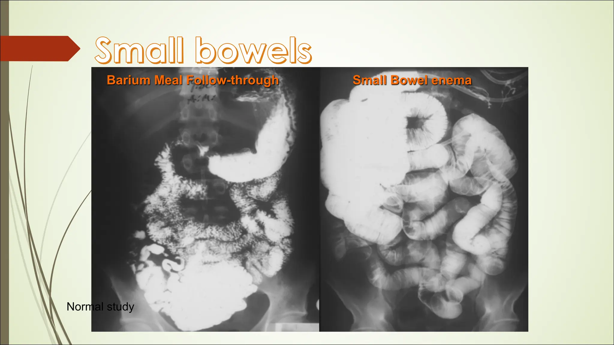 13- RADIOLOGY DISEASES OF GASTROINTESTINAL TRACT.pdf