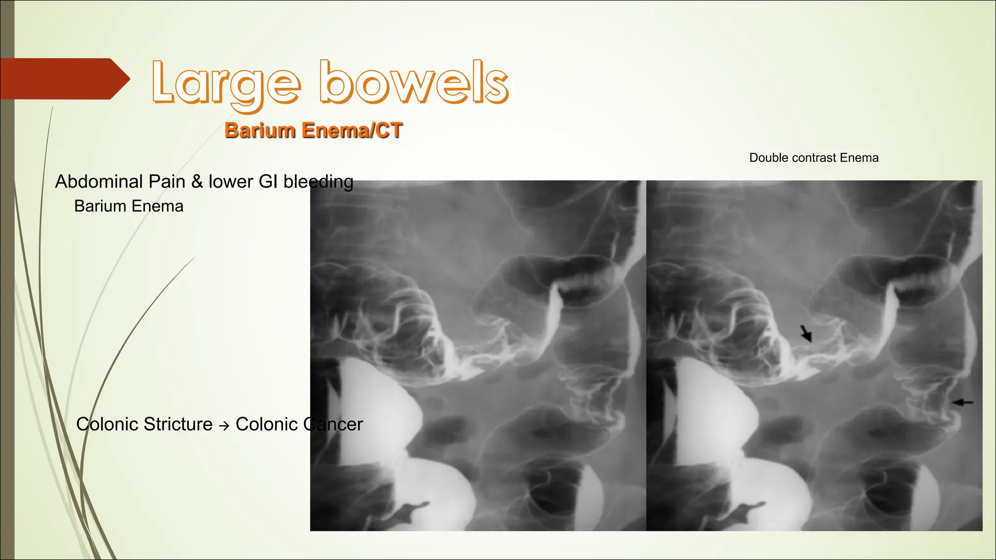13- RADIOLOGY DISEASES OF GASTROINTESTINAL TRACT.pdf
