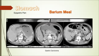 Hampton Line 13- RADIOLOGY DISEASES OF GASTROINTESTINAL TRACT.pdf