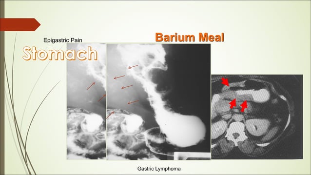 13- RADIOLOGY DISEASES OF GASTROINTESTINAL TRACT.pdf